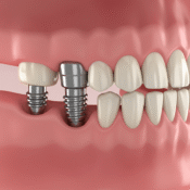 implantes dentales implantes dentales